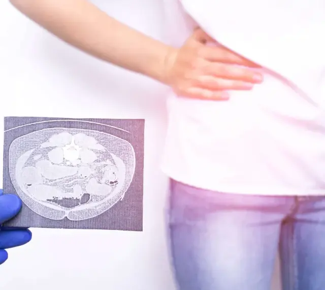 Lekarz pokazuje tomografię jamy brzusznej, sugerującą nieostre zapalenie wyrostka objawy. Pacjentka trzyma się za brzuch.