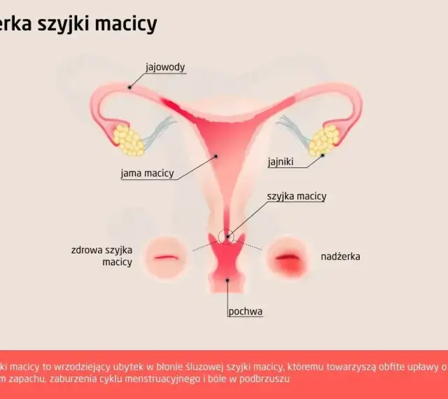 Ilustracja przedstawia budowę narządów rodnych kobiety z zaznaczoną nadżerką szyjki macicy.