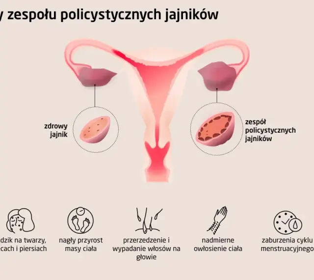 Ilustracja pokazuje budowę macicy i jajników, porównując zdrowy jajnik z tymi w zespole PCOS. Wymienia też typowe pcos objawy: trądzik, przyrost masy ciała, wypadanie włosów, nadmierne owłosienie i zaburzenia cyklu.
