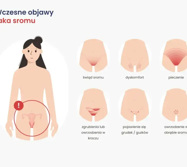 Ilustracja pokazuje wczesne objawy raka sromu: świąd, dyskomfort, pieczenie, zgrubienia, owrzodzenia, grudki i guzki.