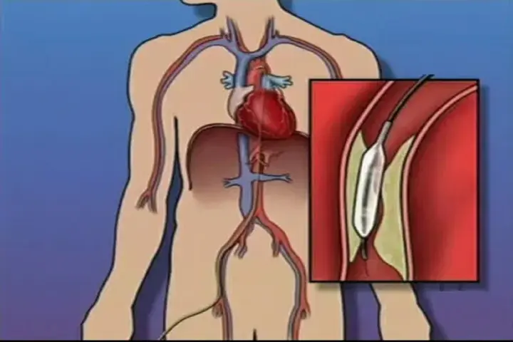Ilustracja przedstawia serce i naczynia krwionośne z powiększeniem balonu w tętnicy.