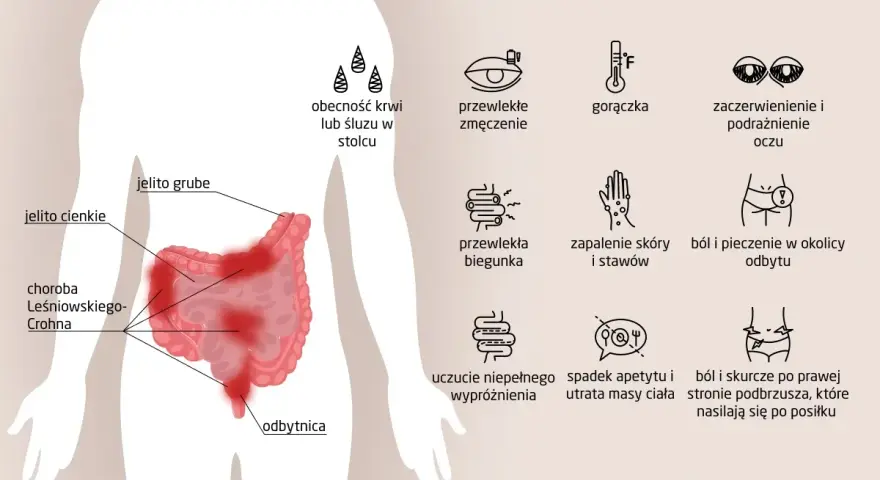 Objawy choroby Leśniowskiego-Crohna: krew w stolcu, zmęczenie, gorączka, problemy z oczami, biegunka, bóle brzucha, zapalenie skóry i stawów.