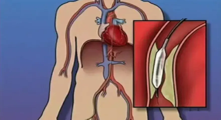 Ilustracja przedstawia serce i naczynia krwionośne z powiększeniem balonu w tętnicy.