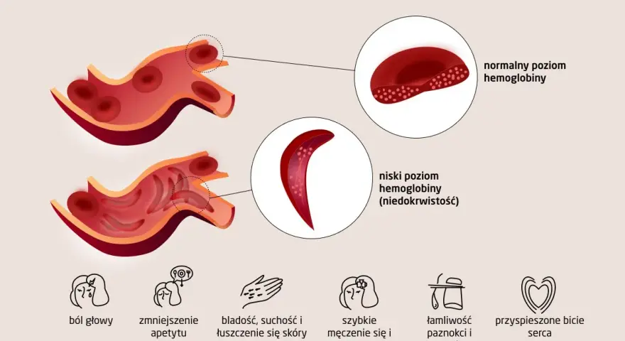 Ilustracja porównująca krwinki czerwone przy normalnym i niskim poziomie hemoglobiny, z ikonami objawów.
