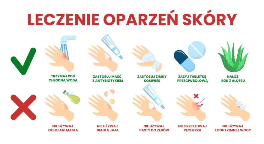 Ilustracja pokazuje leczenie oparzeń skóry: chłodna woda, maść z antybiotykiem, zimny kompres, tabletki przeciwbólowe, sok z aloesu. Unikaj masła, jajek, pasty do zębów, lodu.