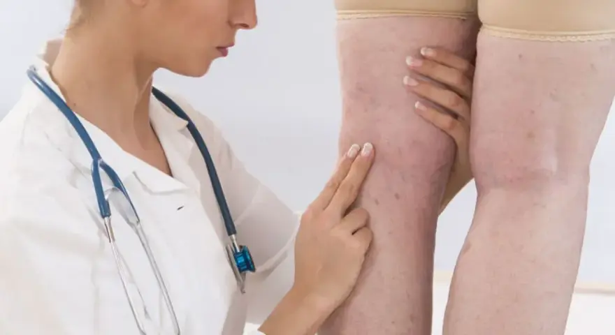 Lekarz bada nogi pacjentki z widocznymi żylakami. D-dimery a stan zapalny – ważny wskaźnik diagnostyczny.