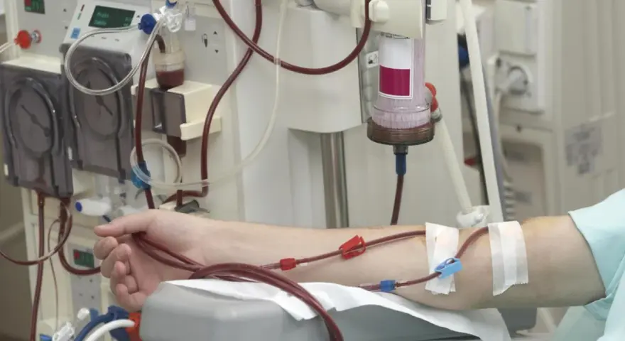 Ramię pacjenta podłączone do aparatury dializacyjnej z widocznymi przewodami i filtrem.