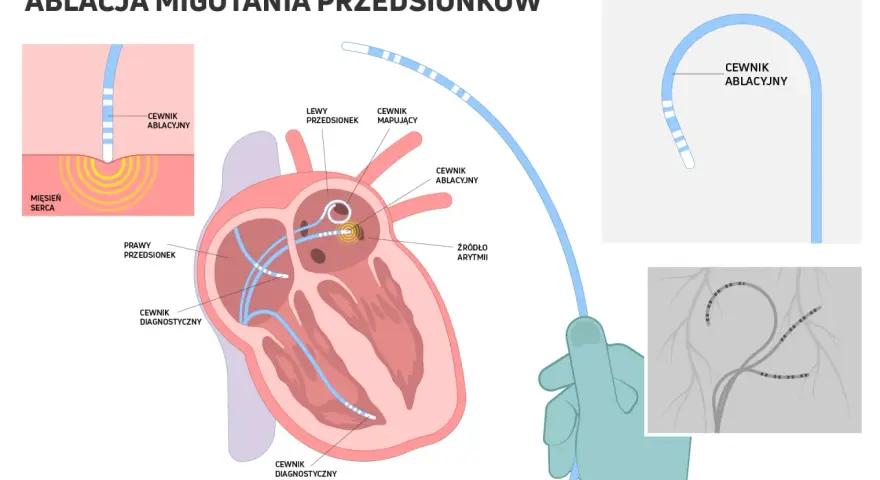 Ilustracja przedstawia schemat ablacji serca z cewnikami diagnostycznymi i ablacyjnymi w sercu.