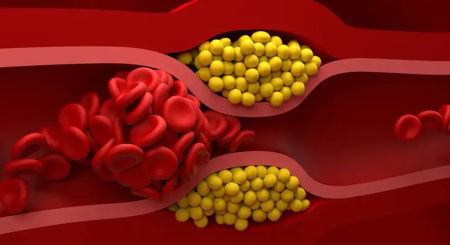 Zator w naczyniu krwionośnym: czerwone krwinki i żółte złogi. Badanie lipoproteiny pomoże ocenić ryzyko.