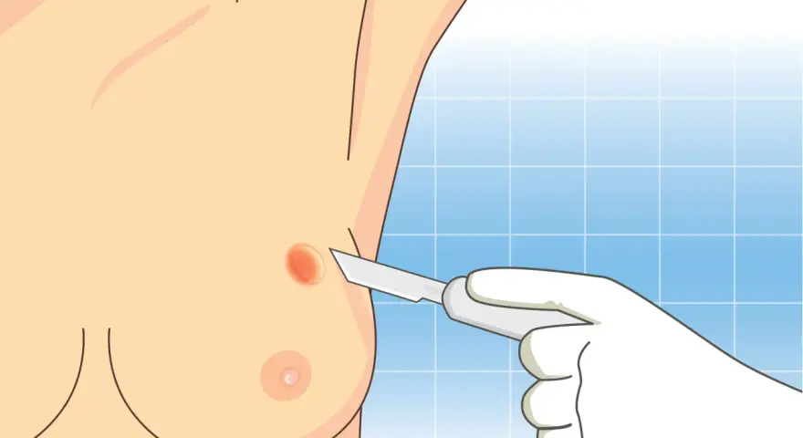 Ilustracja przedstawia biopsję piersi, gdzie skalpel zbliża się do zmiany na skórze.