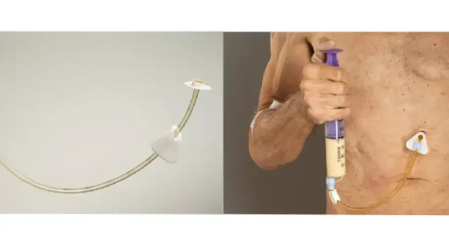 Gastrostomia endoskopowa (PEG) - przyrząd i zastosowanie.