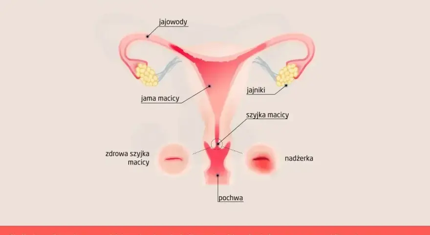 Ilustracja przedstawia budowę narządów rodnych kobiety z zaznaczoną nadżerką szyjki macicy.