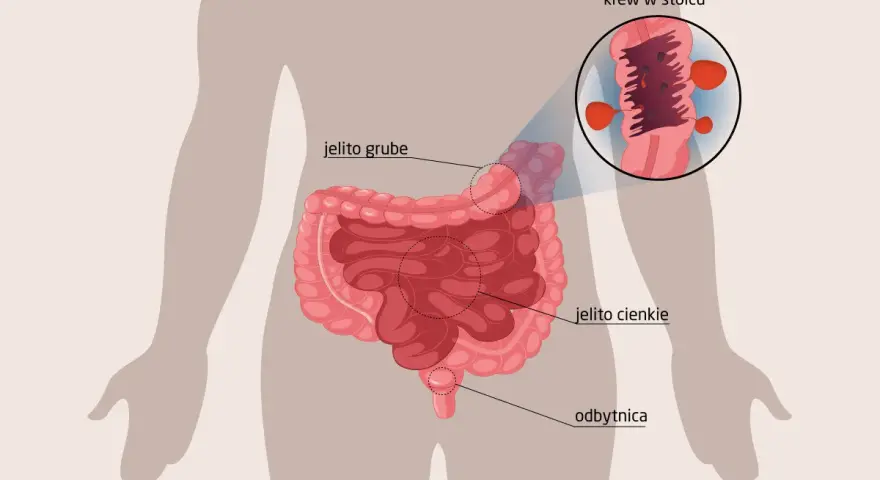 Ilustracja układu pokarmowego z zaznaczonym jelitem grubym, cienkim i odbytnicą. Powiększenie pokazuje krew w stolcu.