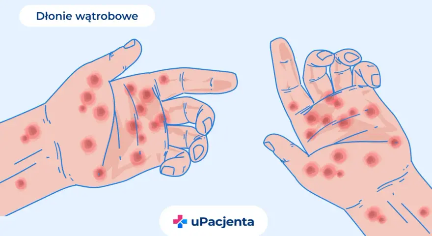 Dłonie z czerwonymi plamkami, ilustracja medyczna.