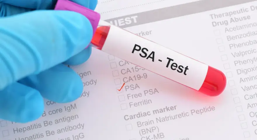 Probówka z krwią do badania PSA na tle formularza medycznego z zaznaczonym testem PSA.