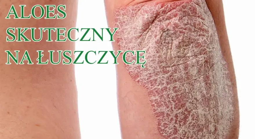 Czy jest nowy lek na łuszczycę? Odkryj najnowsze terapie i ich skuteczność