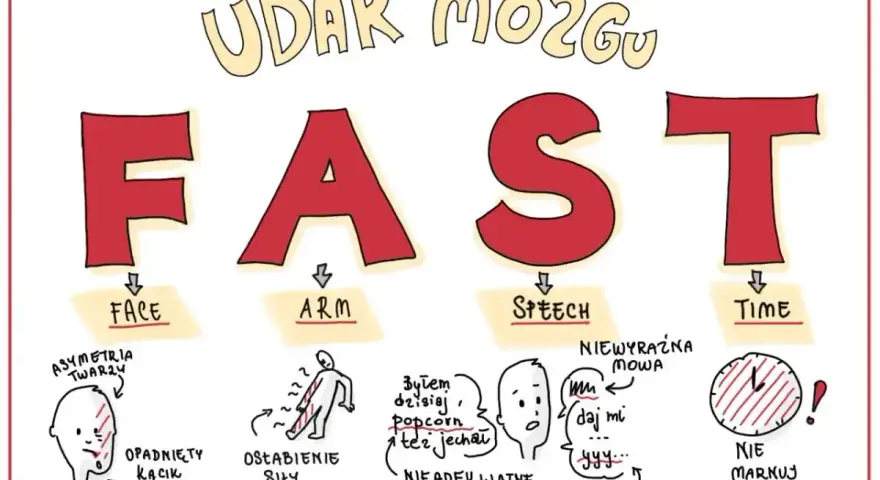 Ilustracja przedstawia akronim FAST (Face, Arm, Speech, Time) opisujący objawy udaru mózgu.