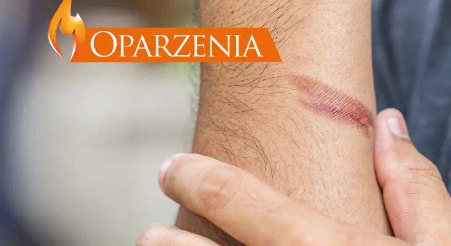 Dłoń z widocznym oparzeniem i napisem "Oparzenia".