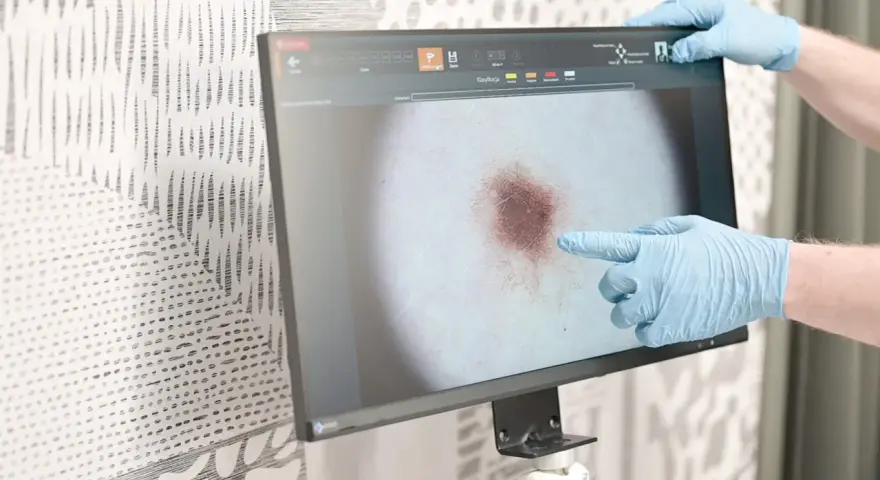 Dłoń w niebieskiej rękawiczce wskazuje na powiększone znamię na ekranie dermatoskopu.