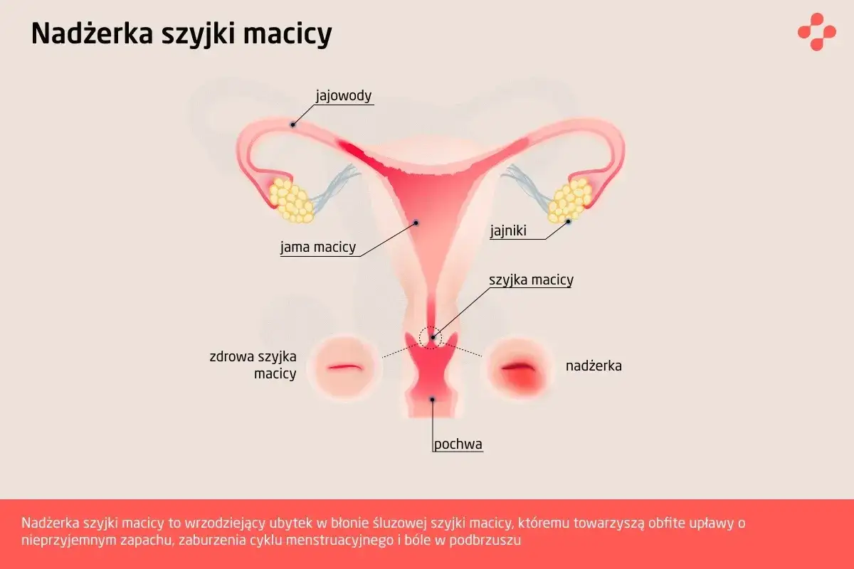 Ilustracja przedstawia budowę narządów rodnych kobiety z zaznaczoną nadżerką szyjki macicy. Widoczna jest zdrowa szyjka macicy obok tej zmienionej chorobowo.