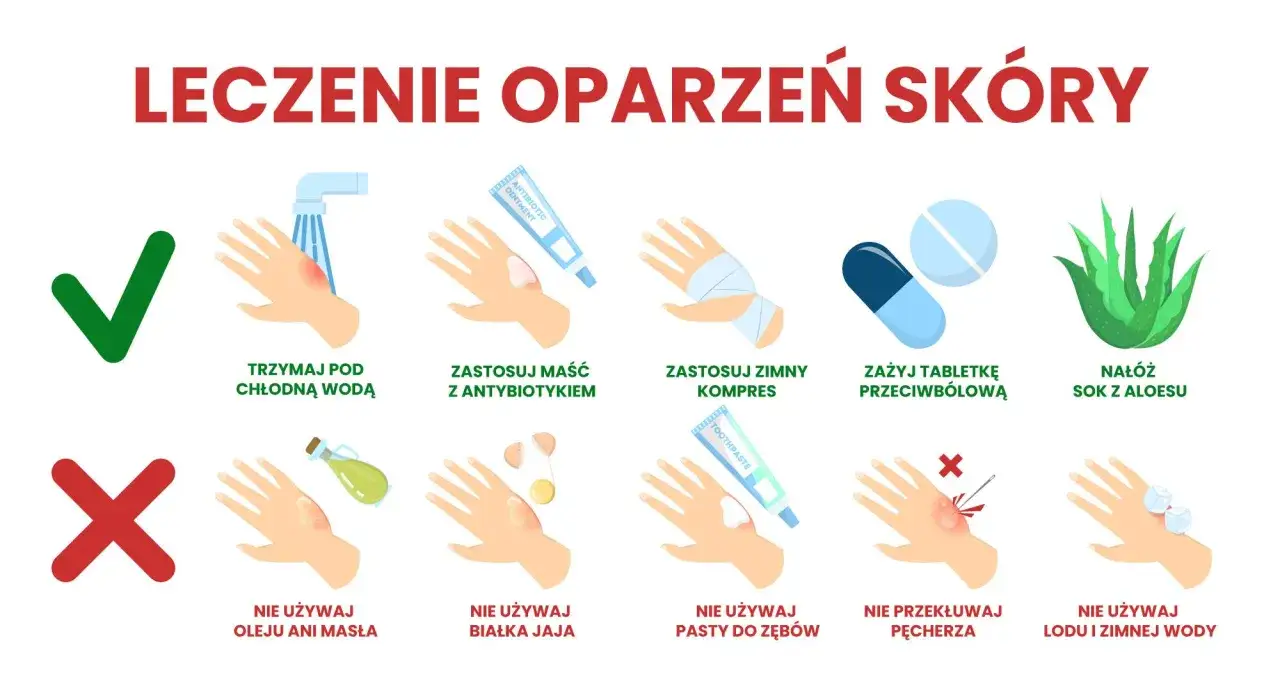Ilustracja pokazuje, jak leczyć oparzenia skóry: chłodna woda, maść z antybiotykiem, zimny kompres, tabletki przeciwbólowe, sok z aloesu. Unikaj masła, jajka, pasty do zębów, lodu. Nie przekłuwaj pęcherzy.
