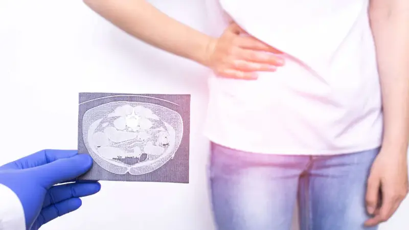 Lekarz pokazuje tomografię jamy brzusznej, sugerującą nieostre zapalenie wyrostka objawy. Pacjentka trzyma się za brzuch.