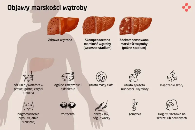 Ilustracja przedstawia objawy marskości wątroby: ból brzucha, zmęczenie, utratę masy ciała, żółtaczkę, obrzęki, gorączkę i zmiany skórne.