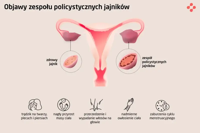 Ilustracja pokazuje budowę macicy i jajników, porównując zdrowy jajnik z tymi w zespole PCOS. Wymienia też typowe pcos objawy: trądzik, przyrost masy ciała, wypadanie włosów, nadmierne owłosienie i zaburzenia cyklu.
